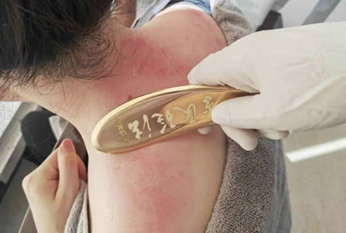刮痧适用于哪些疾病