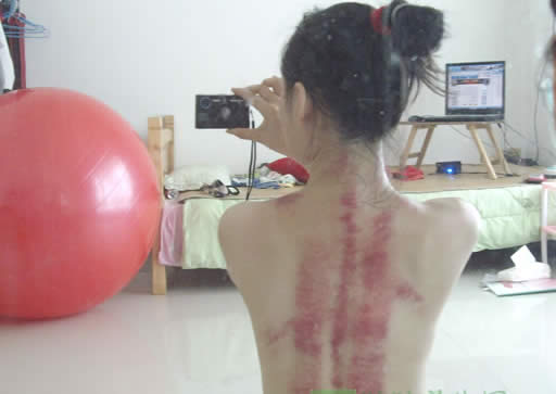 民间传统医学刮痧的原理