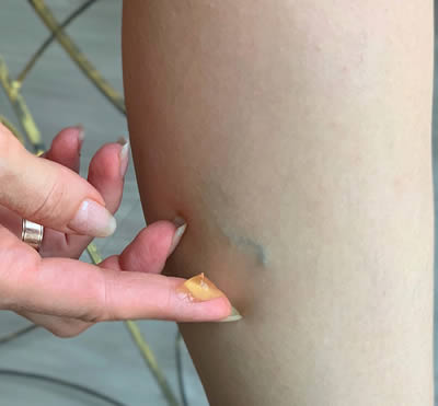 艾灸箕门对血栓动脉有良效