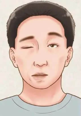 面瘫