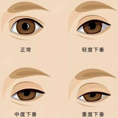 治睑下垂